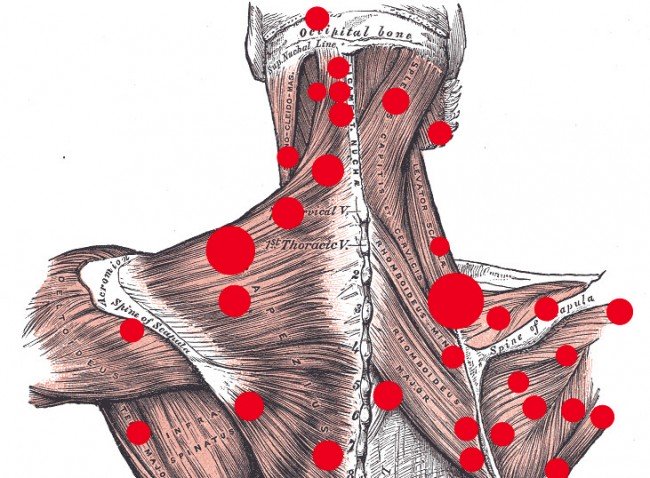 Trapezius Trigger Points: Causes, Treatment, and Prevention